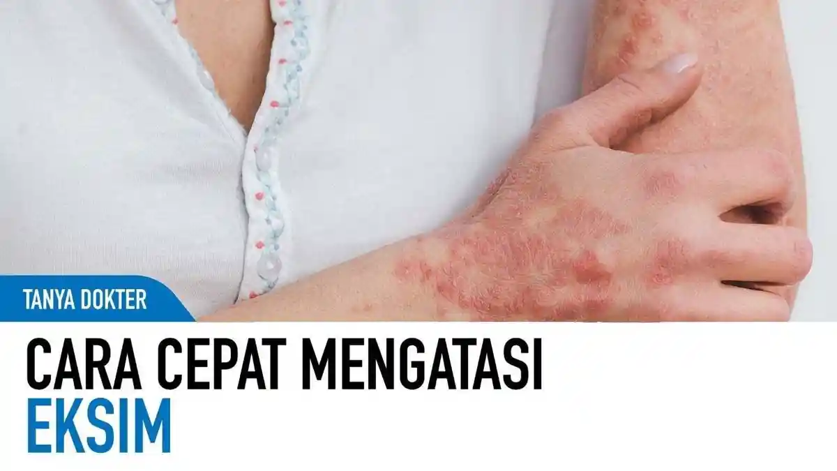 5 Cara Mengobati Eksim Secara Alami Dengan Minyak Kelapa, Madu, Cuka Sari Apel, Dijamin Manjur!