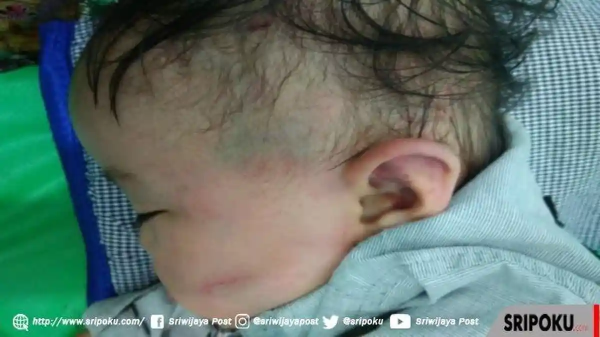 Muntah Darah Dianiaya Ayah Tiri, Balita 14 Bulan di Sumsel Trauma hingga Begini Saat Didekati Pria