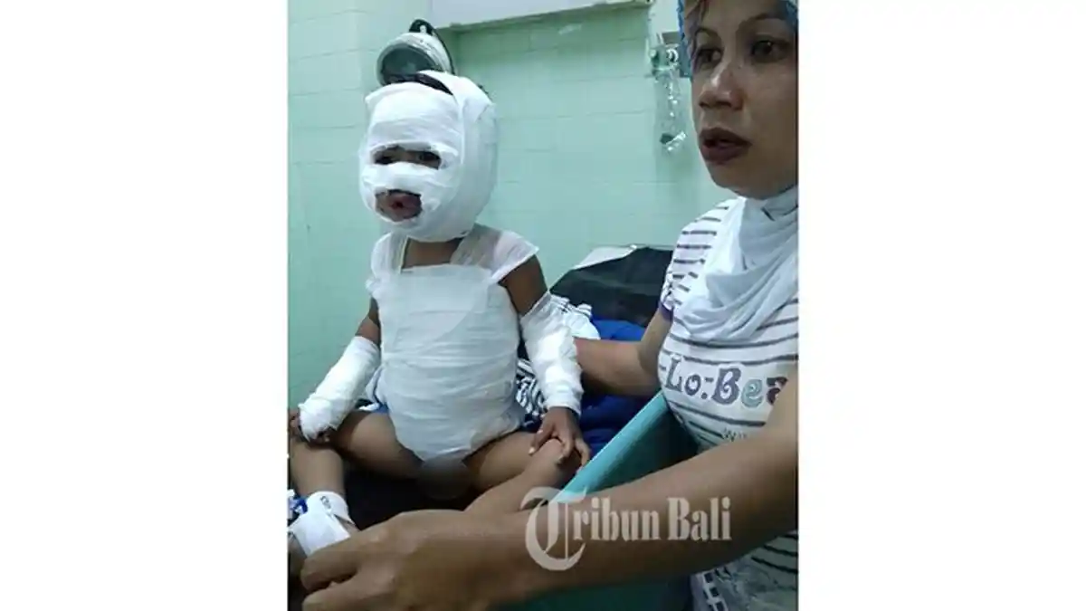 Tubuh Bocah Berusia 3 Tahun Terbakar 45 Persen