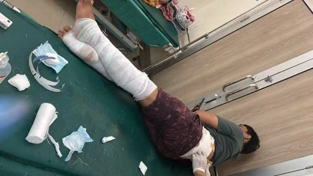 Gegara Cemburu , Pria di Sukabumi Siram Air Keras ke Istri dan Kedua Anak Tirinya