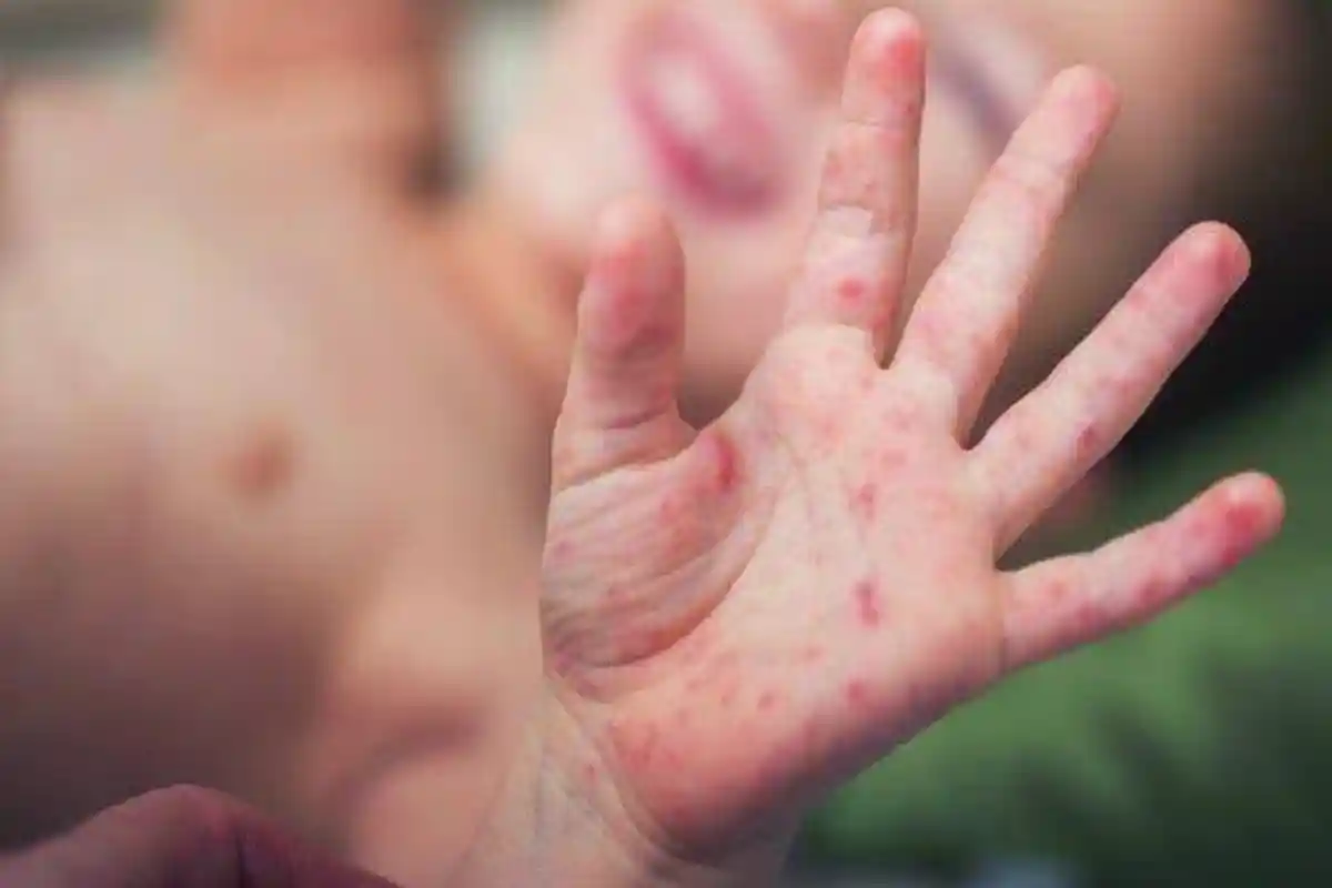 Anak Meninggal karena Campak Bertambah Jadi 12 Orang, Dinkes P2KB Sumenep: Kami Mohon Maaf