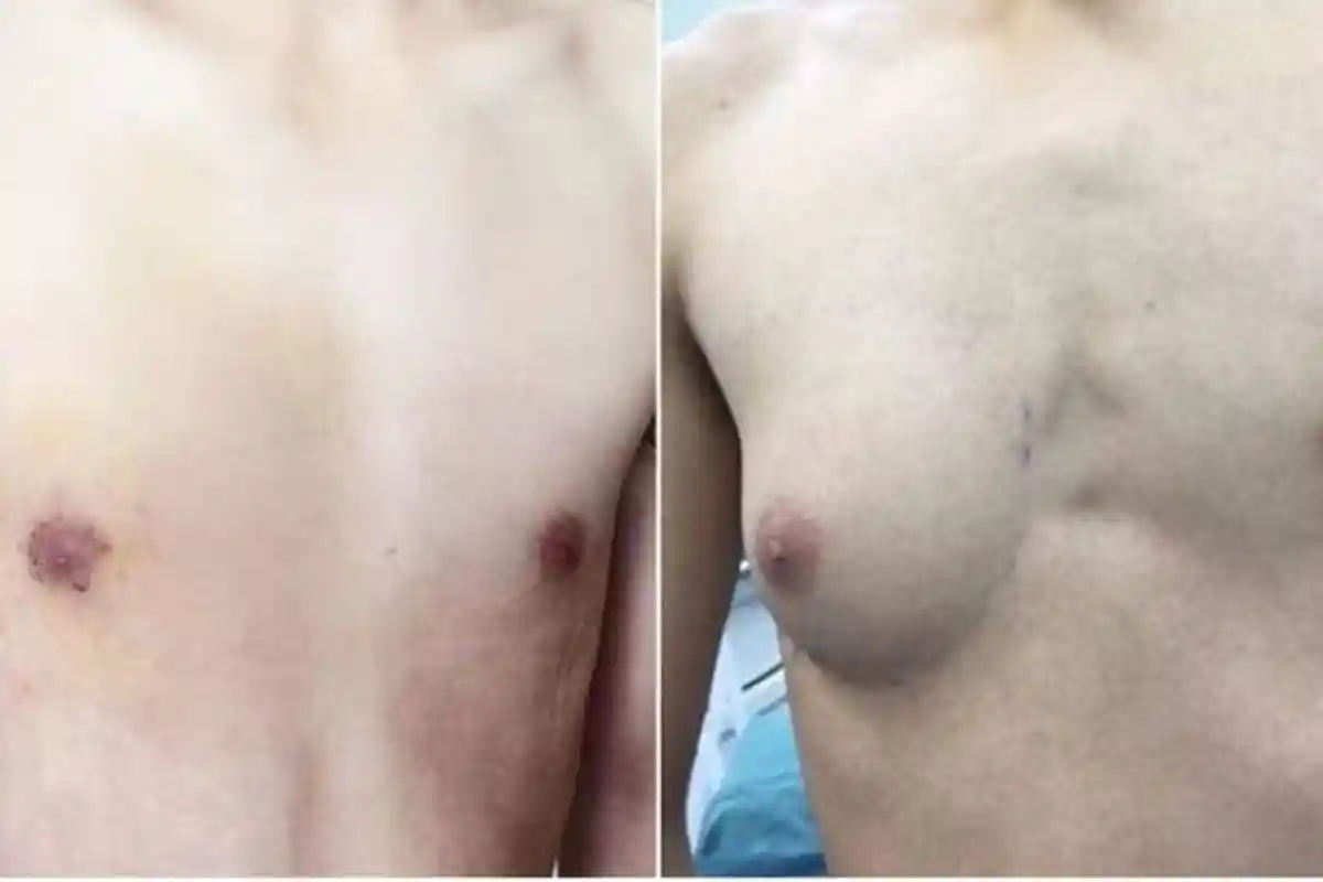 Payudara Pria Ini Tumbuh Membesar Gara-gara Sering Makan Makanan Cepat Saji