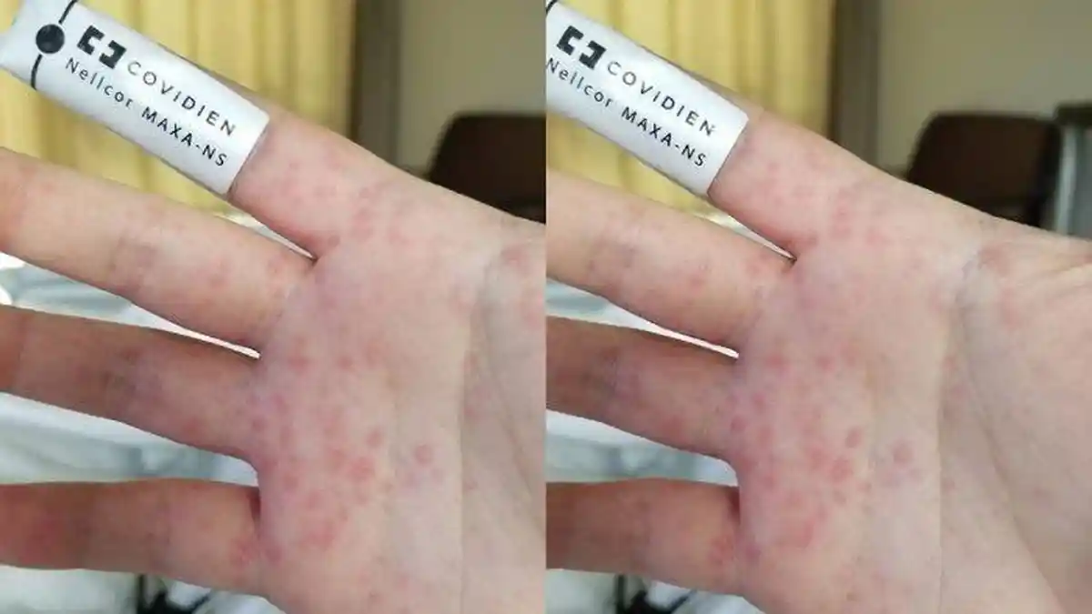 APA Itu Stevens Johnson Syndrome? Kelainan Langka pada Kulit, Alat Kelamin dan Mata
