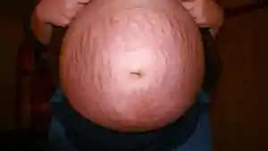 ilustrasi-stretch-mark-saat-hamil.jpg