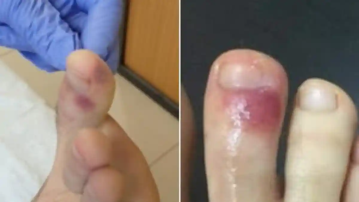 Memar dan Ruam di Kaki Bisa Jadi Gejala Baru Corona pada Anak dan Remaja