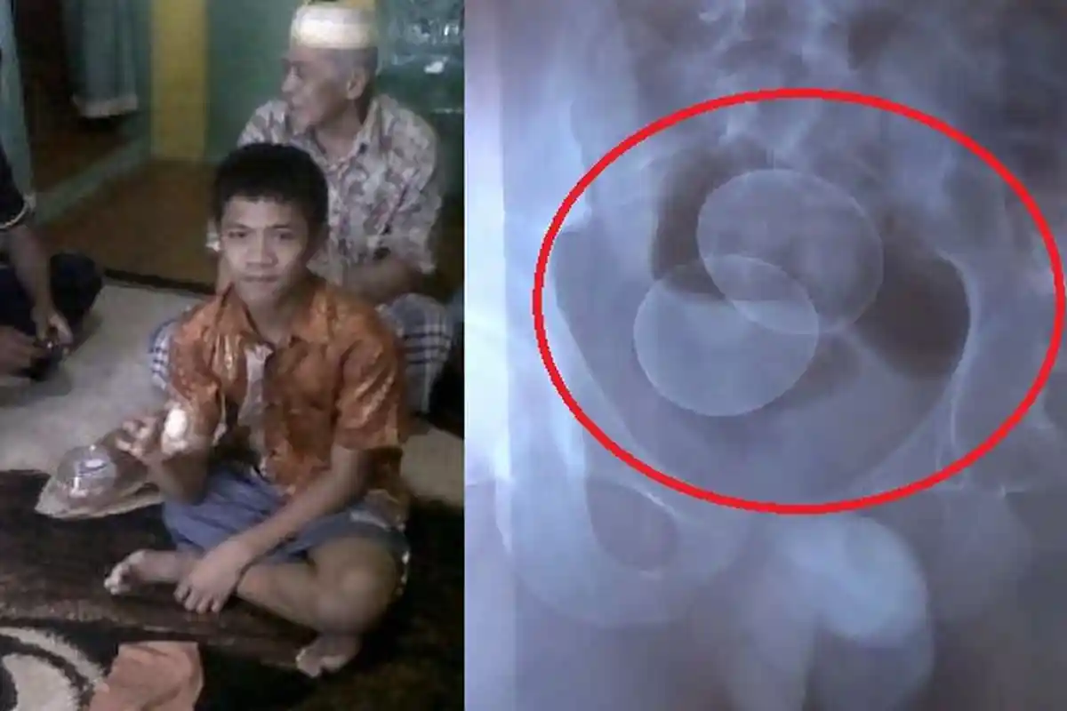 Fakta Bocah Bertelur di Sulsel, dari Telur Ayam sampai Jumlahnya yang 21 Butir