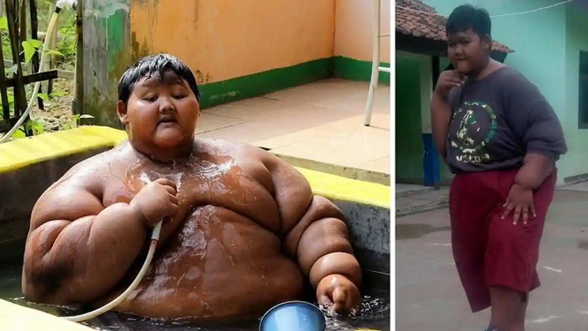 Masih Ingat Bocah Terberat di Dunia asal Karawang? Sekarang, Katanya Makan Enam Sendok Sudah Kenyang