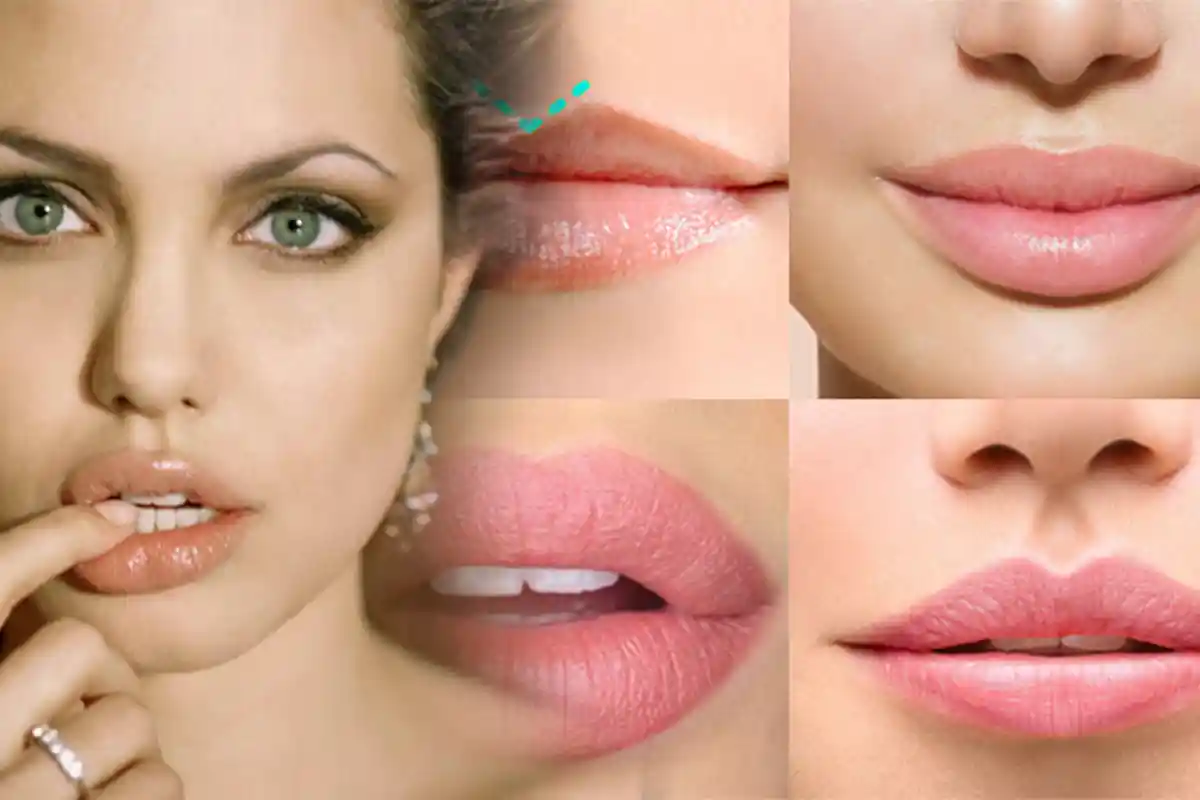 Memancungkan Hidung dan Menambah Volume Bibir Instan dengan Filler, Amankah?