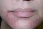 dermatitis-perioral.jpg