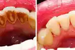 cara-menghilangkan-karang-gigi_20180429_233850.jpg