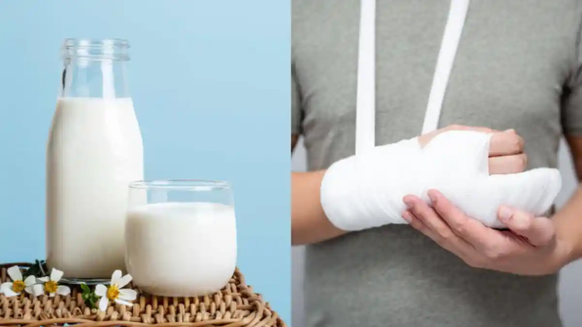 Benarkah Minum Susu Beruang Bantu Penyembuhan Patah Tulang? Perhatikan Asupan Makanan