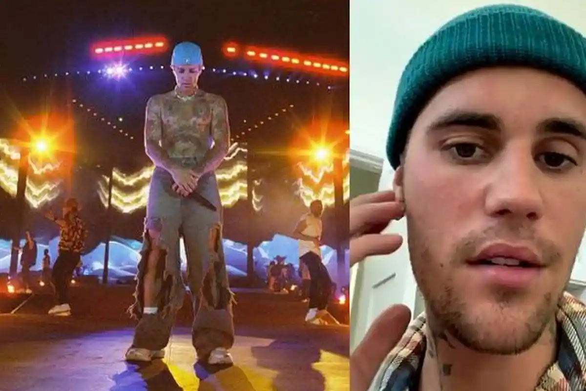 Apa Itu Sindrom 'Ramsay Hunt' yang Dialami Justin Bieber? Sebagian Wajah Lumpuh, Ini Gejala Utamanya