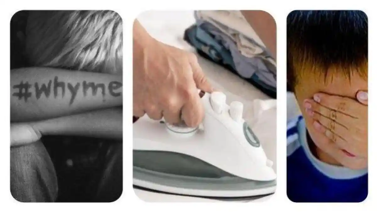 Anaknya Disetrika Guru Gegara Lupa Kerjakan PR, Ayah Ini Menangis: Seperti Penyiksaan Zaman Perang