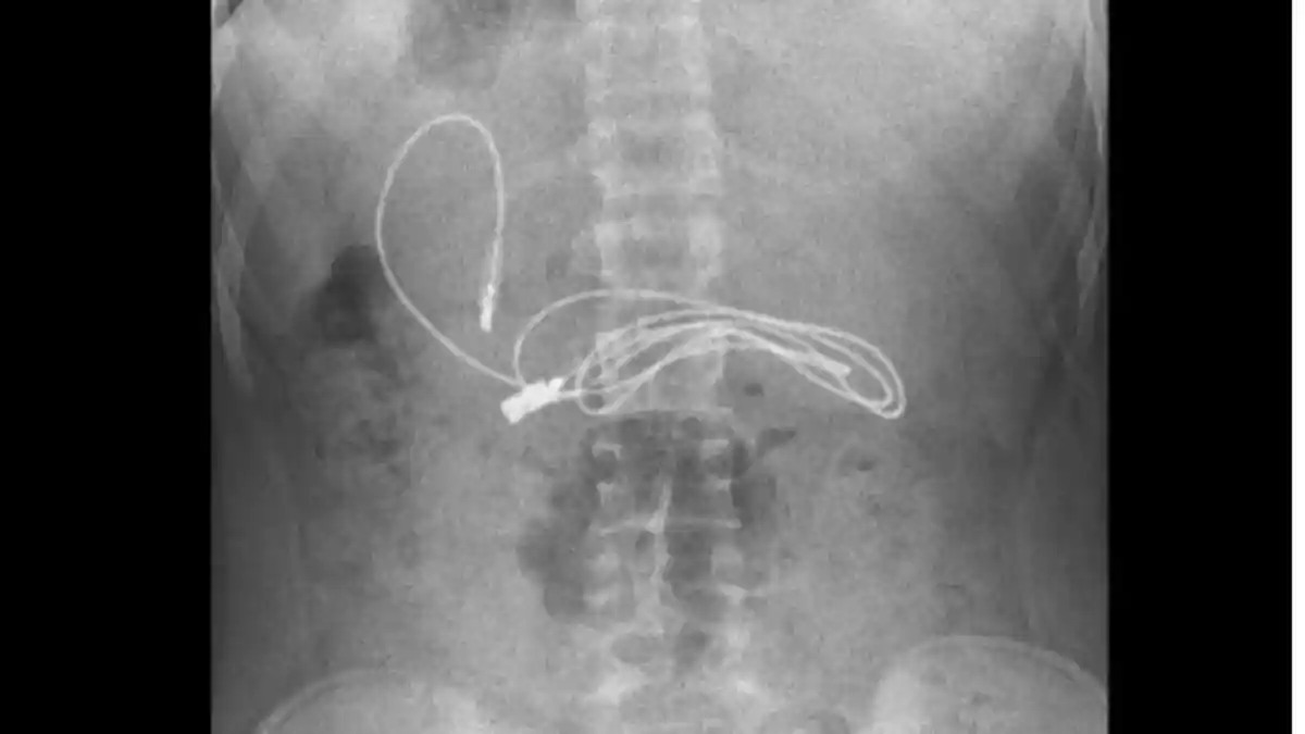 Awalnya Sakit Perut dan Mual, Dokter Syok Temukan Benda Ini di Dalam Tubuh Remaja