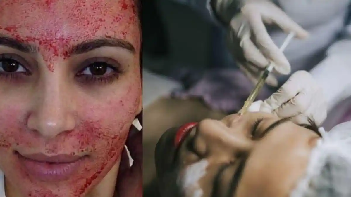 Manfaat Vampire Facelift bagi Kulit, Seperti yang Pernah Dilakukan Kim Kardashian