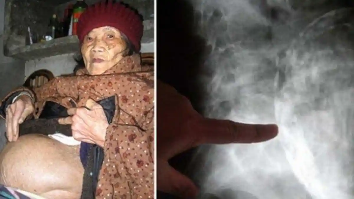 KISAH Nenek 92 Tahun yang Mengandung Selama Puluhan Tahun, Begini Kondisi Bayinya