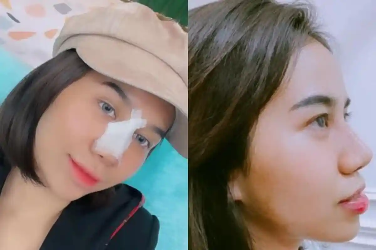 PERDANA Mayang Akhirnya Pamer Wajah Setelah Operasi Hidung, Doddy Sudrajat: Bagus dan Natural