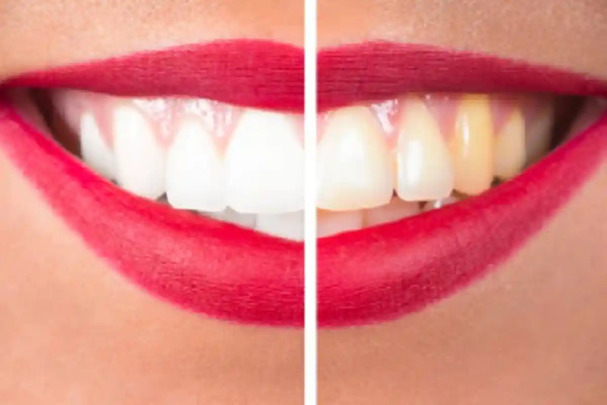 Deretan Minuman yang Dapat Berdampak pada Kesehatan Gigi, Kurangi Konsumsi Minuman Bersoda