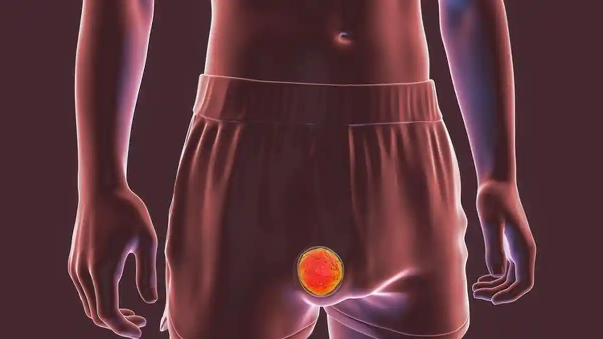 Bahaya Tumor Testis Pada Pria yang Tidak Disadari Sejak Awal, Apa Saja?