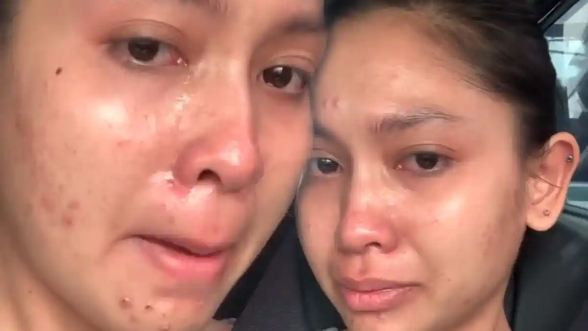 Menangis, Penyanyi Cantik Ungkap Wajah Aslinya yang Jerawatan Tak Semulus di Instagram