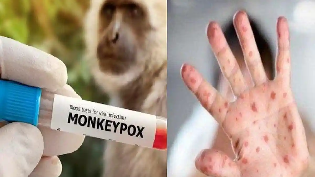Apa Itu Kasus Monkeypox? Penularan Utama Lewat Hubungan Seksual, di Indonesia Tercatat 3 Kasus