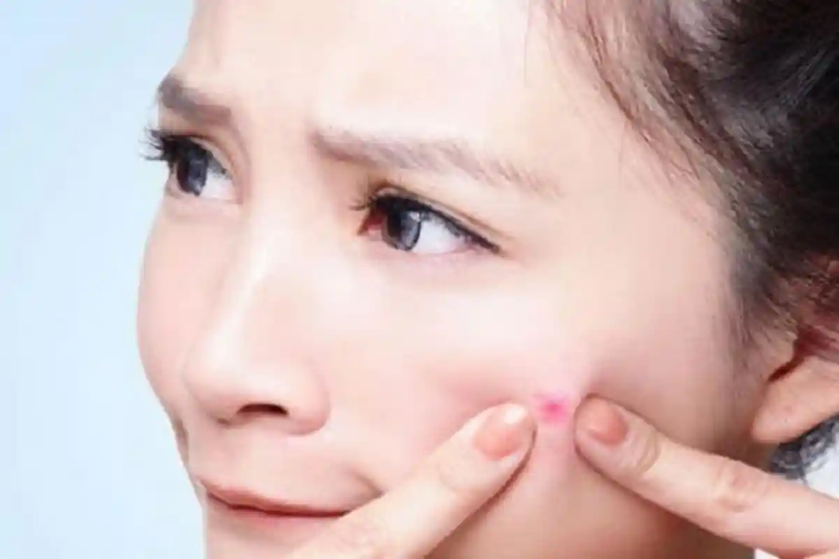 Bukan Makan Kacang, Ini Penyebab Wajah Tak Mulus