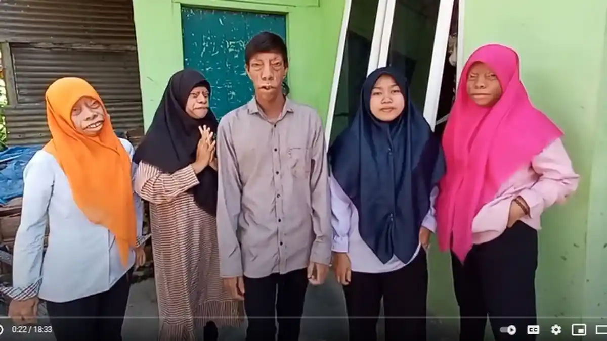 Masih Ingat Keluarga Manurung? Dulu Viral Idap Penyakit Langka di Wajah, Kini Makin Eksis di Medsos