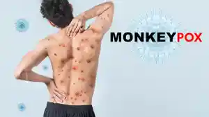 monkeypox-atau-cacar-monyet.jpg