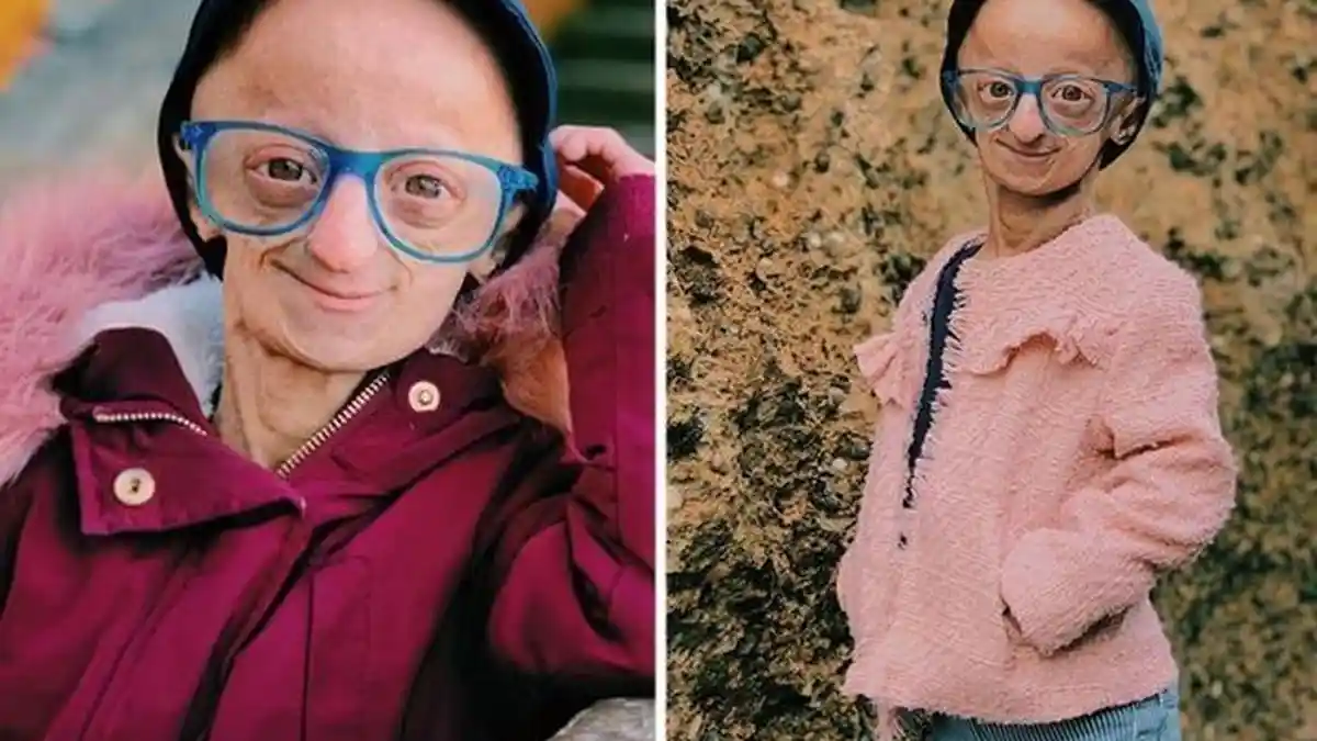 Kisah Claudia Amaral, Wanita Berusia 20 Tahun yang Terlihat Seperti Berusia 140 Tahun