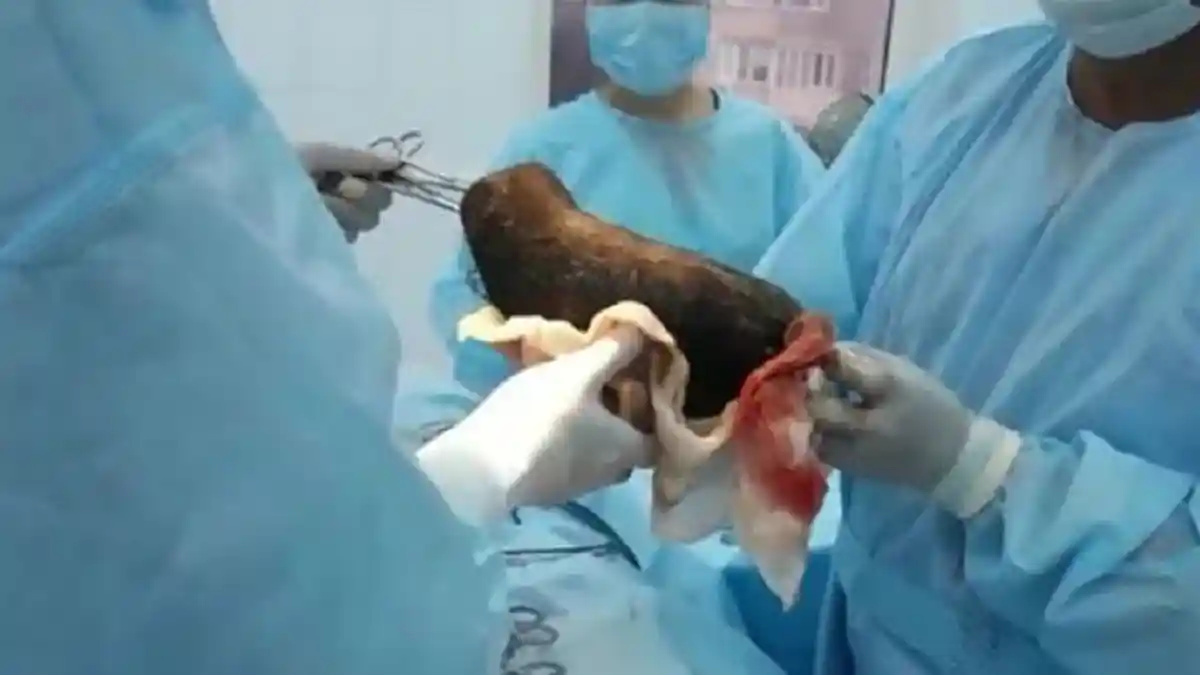 Alami Sakit Perut Memuncak, Dokter Keluarkan Gumpalan Seberat 3,65 Kilogram dalam Perut Gadis Ini