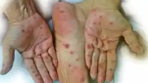 Flu-singapura.jpg