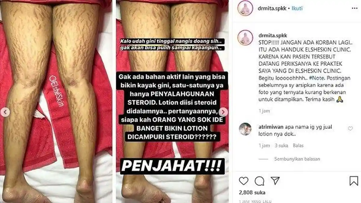 Dokter Ungkap Pasiennya Terima Akibat Mengerikan Karena Krim Pemutih Abal-abal Dibeli Online