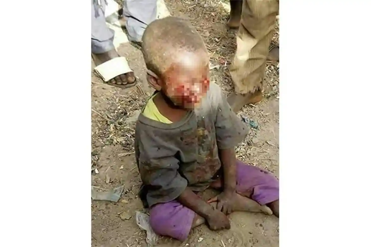 BIADAB! Gara-gara Ngompol di Kasur, Mata Balita Ini Dicongkel Ibu Tirinya