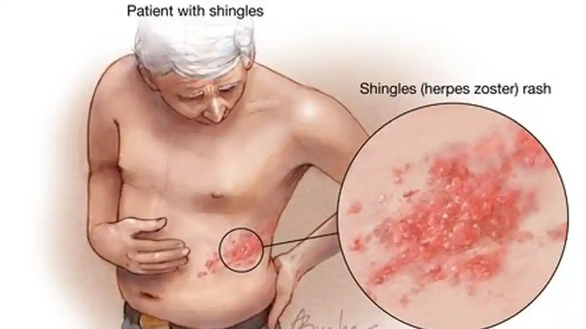 Hati-hati ini Tanda dan Gejala Seseorang Sudah Kena Infeksi Virus Herpes, Bisa Menular !