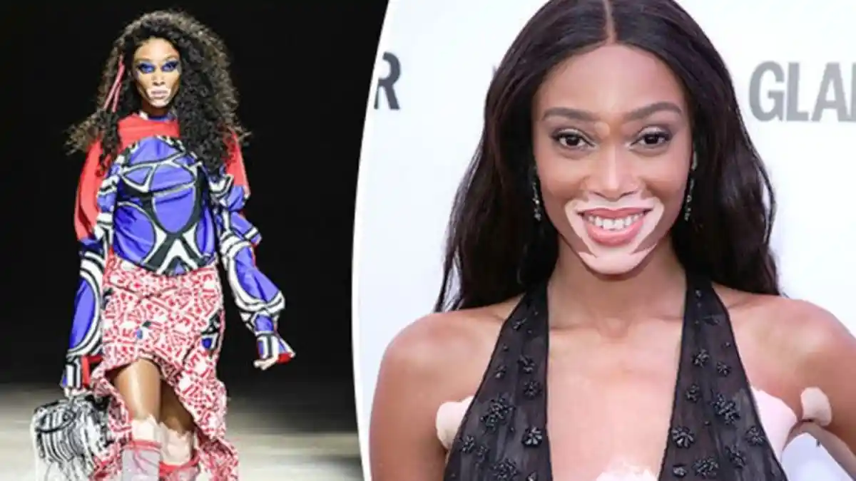 Winnie Harlow, Pengidap Penyakit Kulit Vitiligo yang Menggebrak Victoria’s Secret