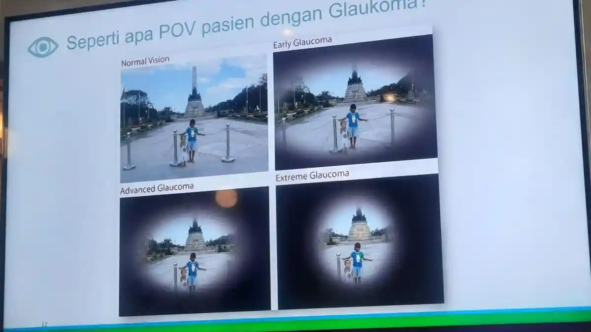 Begini Penglihatan Pasien Glaukoma, Makanya Tak  Disarankan Mengendarai Mobil