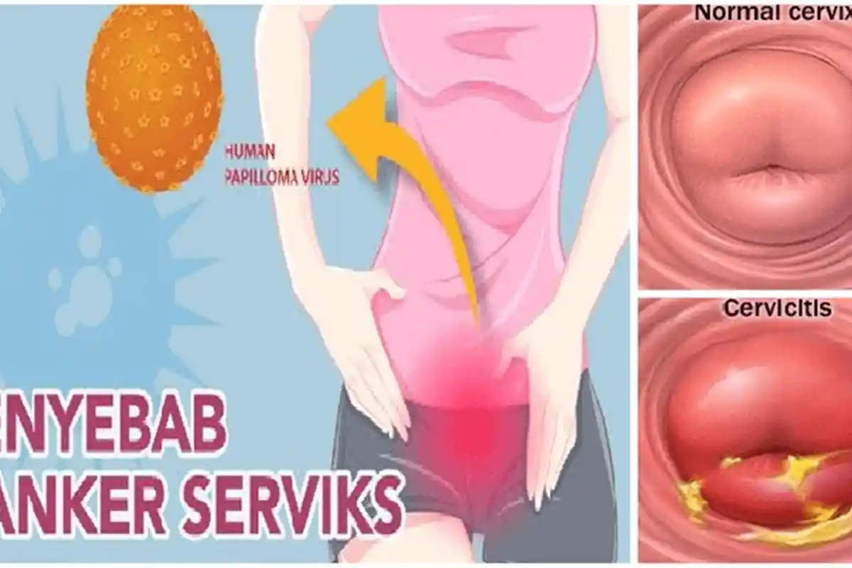 WASPADA Kenali Gejala dan Pemicu Kanker Serviks pada Wanita, Cek Sekarang Sebelum Menyesal