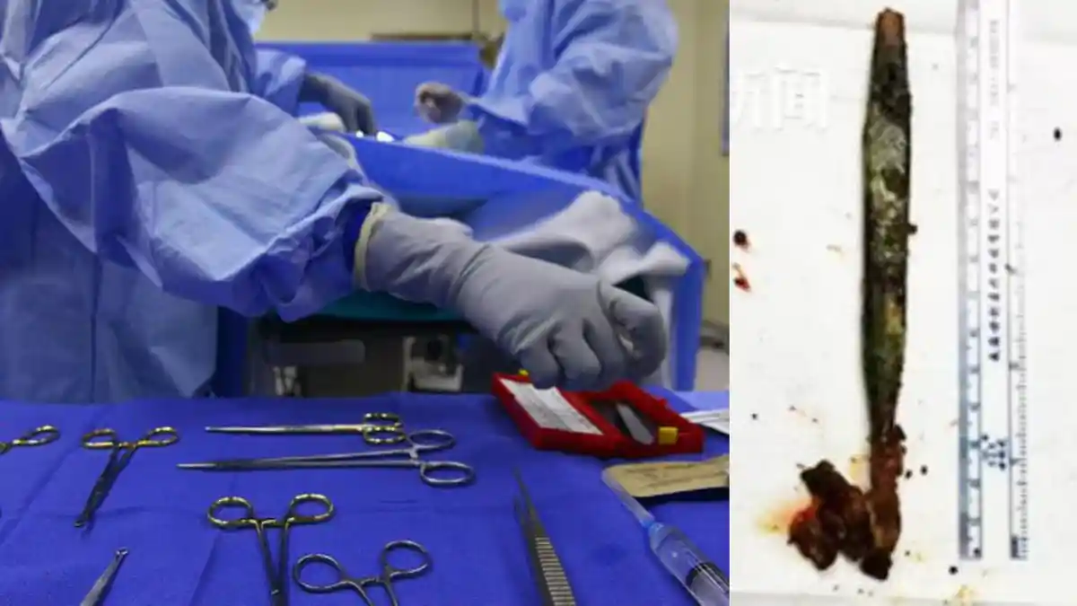 Rasakan Sakit Selama 20 Tahun, Dokter Temukan Sikat Gigi Bersarang di Perut Pria ini