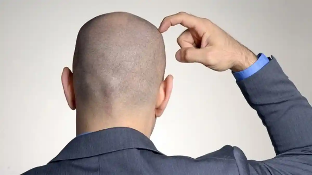 Inilah Gaya Rambut yang Pas Buat yang Hampir Botak!