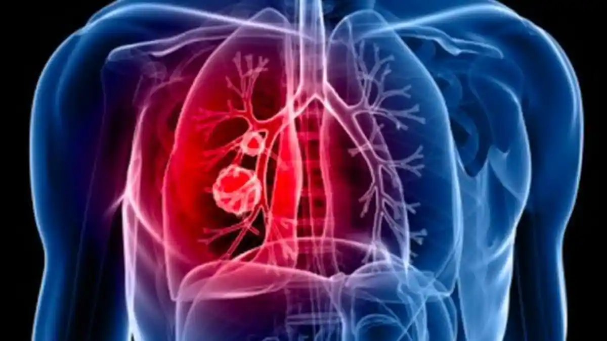 Bahaya Vape dan Kaitannya dengan Kanker Paru-Paru, Berikut Penjelasan Ahli