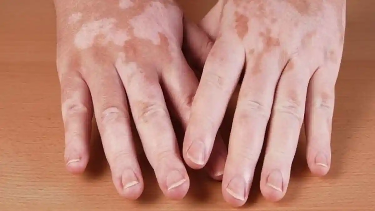 Penyakit Kulit Vitiligo Bisa Diobati, Inilah 4 Metode Terapinya, seperti Penyamaran dengan Kosmetik