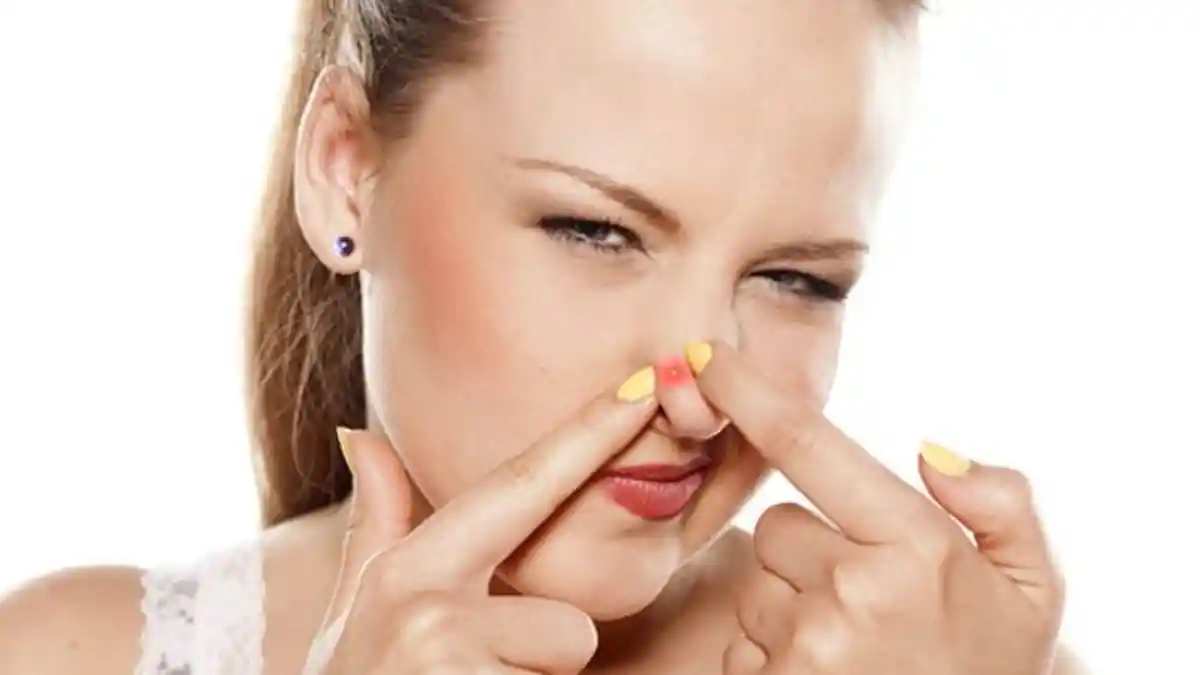 5 Cara Ampuh Mengatasi dan Mencegah Jerawat di Hidung secara Alami, Jangan Dipencet