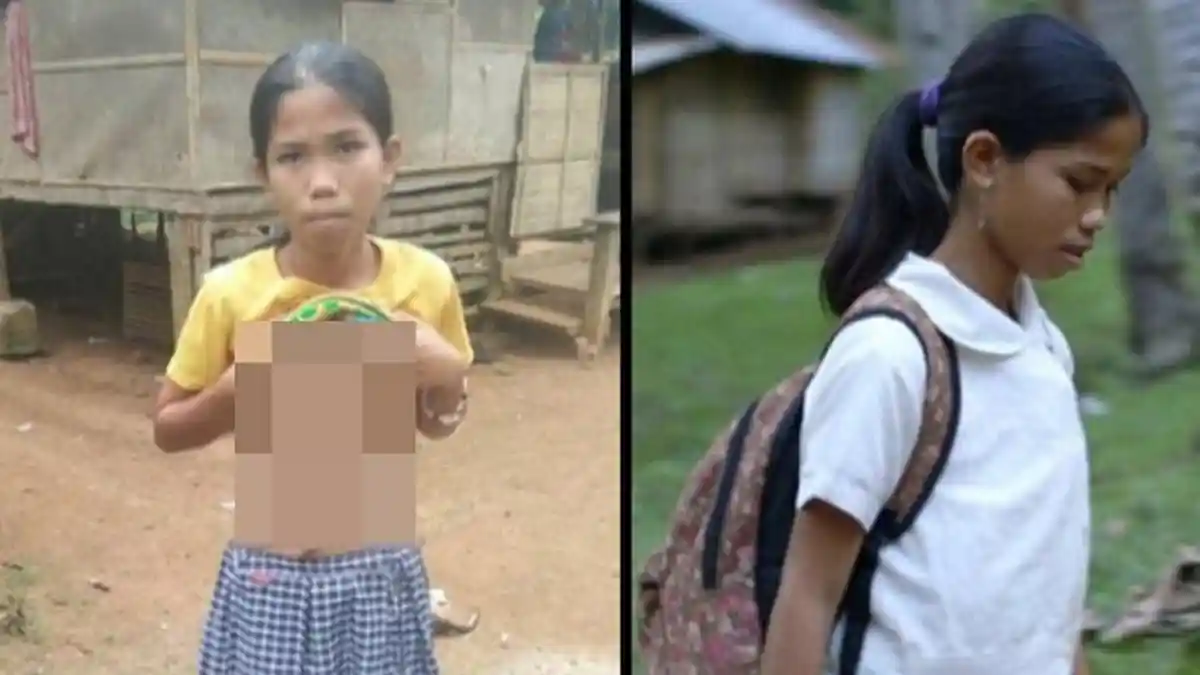 Gadis Ini Lahir Bersama Saudara Kembar Parasitnya, Ia Hidup dengan Dua Tangan Tambahan di Perut