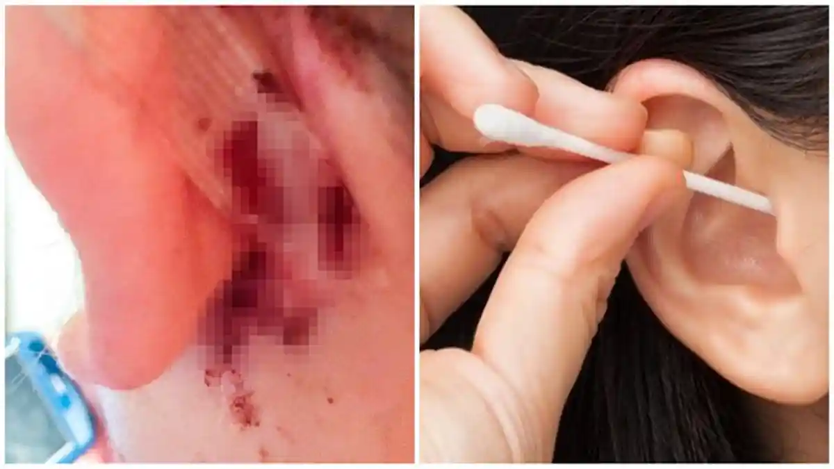 Sering Pakai Cutton Bud Bersihkan Telinga, Wanita ini Alami Infeksi Otak Mematikan