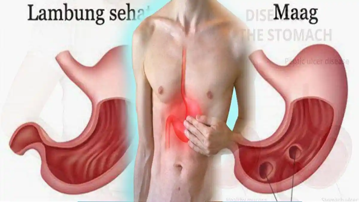 Gejala GERD yang Disebut Asam Lambung Kronis, Apa yang Harus Dihindari?