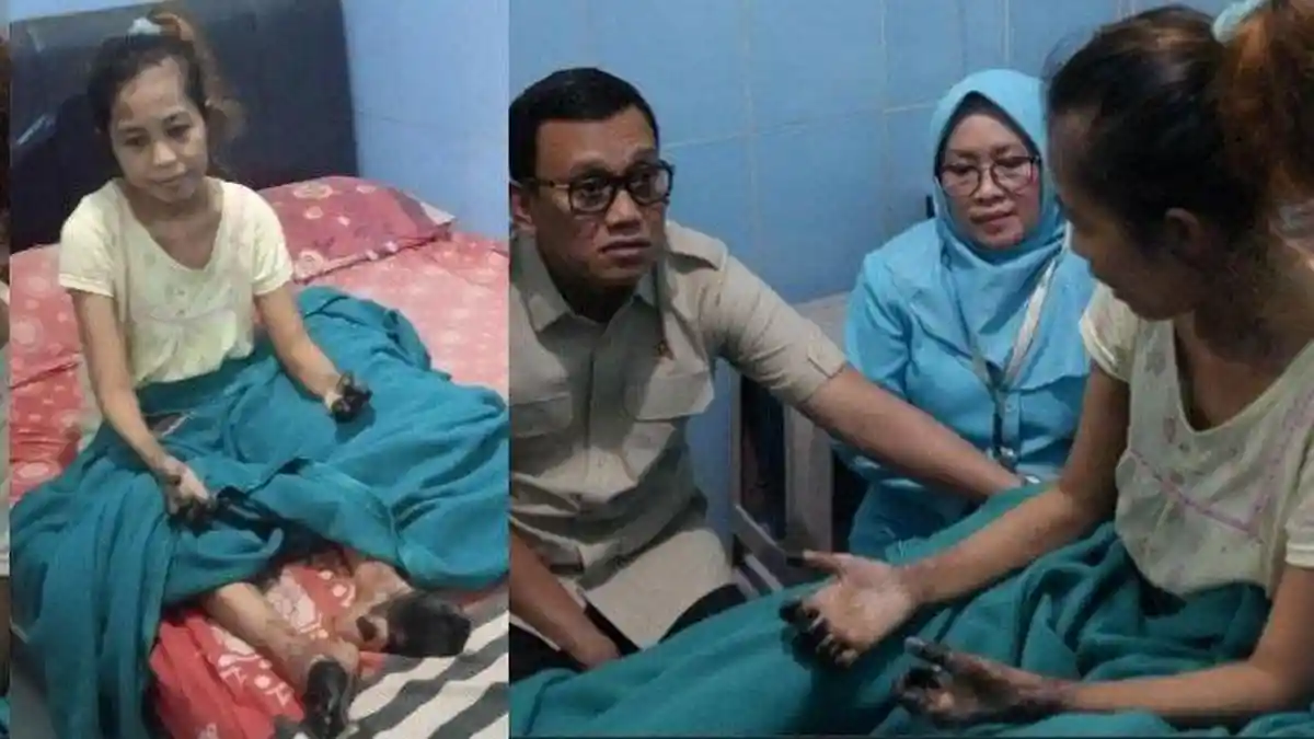 Duduk Perkara Tangan Kaki Septia Rini TKW Jember Menghitam usai Operasi ...