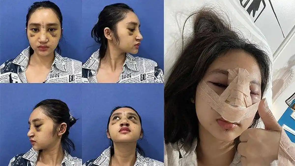 Nasib Anak Farida Nurhan, Alami Infeksi Setelah Beberapa Bulan Pasang Implan Hidung di Thailand