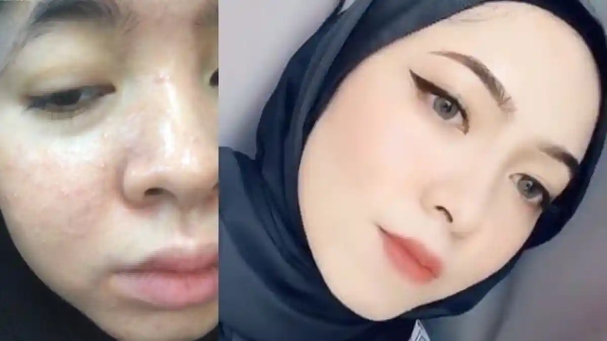 Viral Batal Tunangan Sebab Ditinggalkan Kekasih Akibat Berwajah Tidak Cantik, Alhasil Bisa Glow-Up