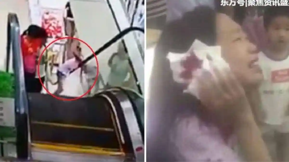 Kepala Gadis Nyaris Putus Saat Naik Eskalator, Alami Pendarahan Hebat di Telinga