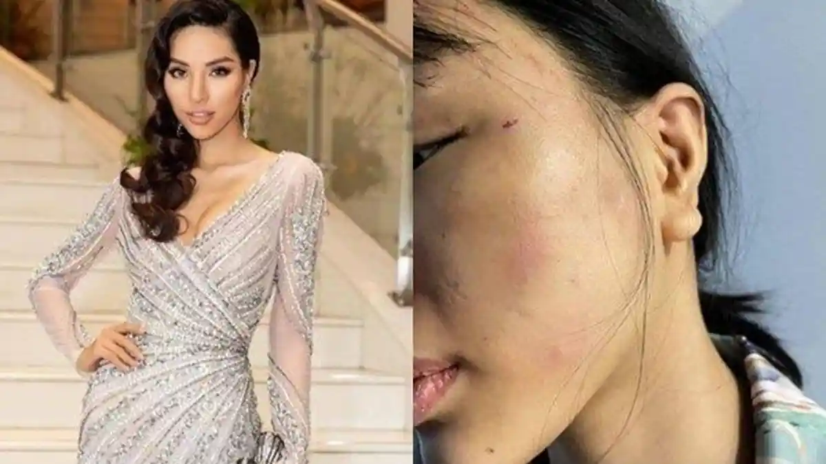 Model Ini Muncul Dengan Wajah Penuh Lebam Setelah 1 Tahun Menghilang, Terkuak Kisah Pilunya